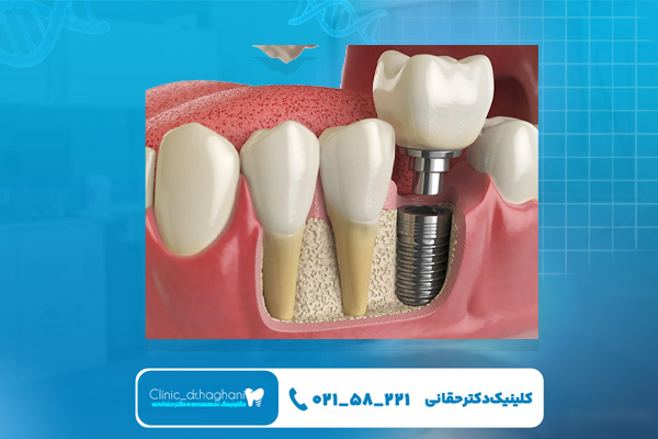 تحلیل استخوان فک در نوجوانان بدون دندان