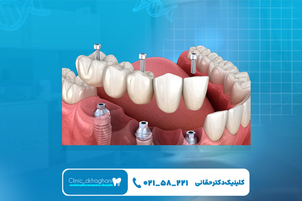 ایمپلنت برای نوجوانان مناسب است