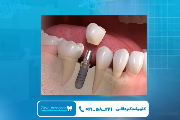 ایمپلنت برای چه افرادی مناسب نیست؟