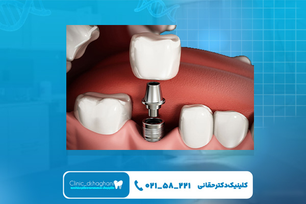 ایمپلنت برای چه افرادی مناسب نیست؟