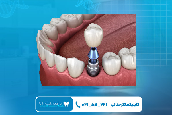 ایمپلنت برای چه افرادی مناسب نیست؟