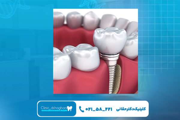 مزیت‌های از ایمپلنت دیجیتال