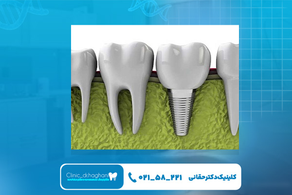 عوامل موثر بر هزینه ایمپلنت دیجیتال
