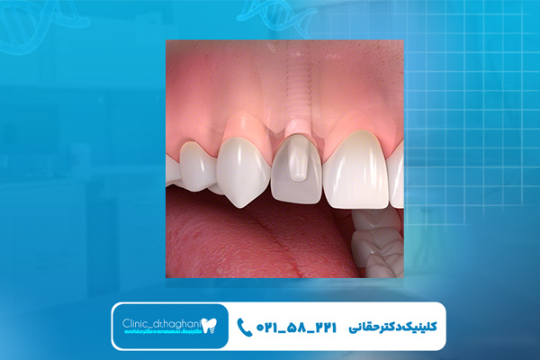 کاشت دندان جلو در بهترین کلینیک دندانپزشکی کاشت دندان جلو در بهترین کلینیک دندانپزشکی