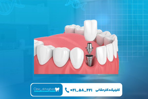 مراحل انجام کاشت دندانهای جلو مراحل انجام کاشت دندانهای جلو