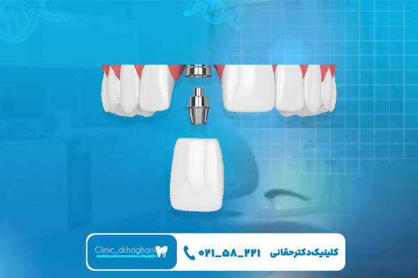 ایمپلنت دندان جلو ایمپلنت دندان جلو