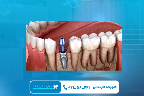 ایمپلنت دندان چیست و چگونه انجام می شود ایمپلنت دندان چیست و چگونه انجام می شود