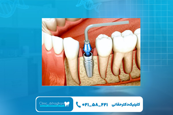 ایمپلنت دندان چیست و چگونه انجام می شود ایمپلنت دندان چیست و چگونه انجام می شود
