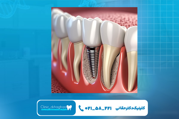 ایمپلنت دندان چیست و چگونه انجام می شود ایمپلنت دندان چیست و چگونه انجام می شود