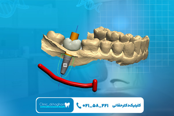 ایمپلنت دیجیتال چقدر هزینه دارد؟