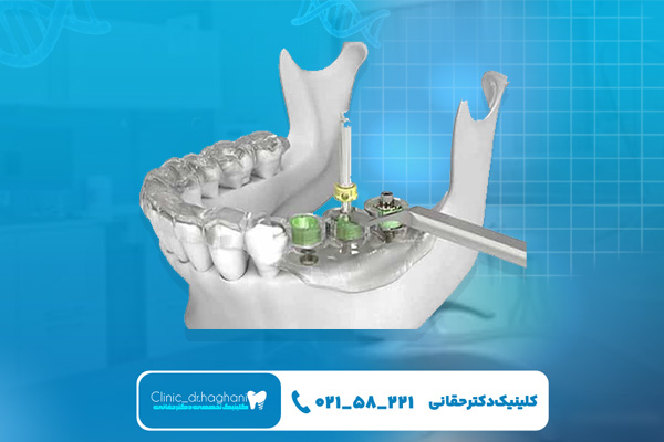 ایمپلنت دیجیتال چقدر هزینه دارد؟