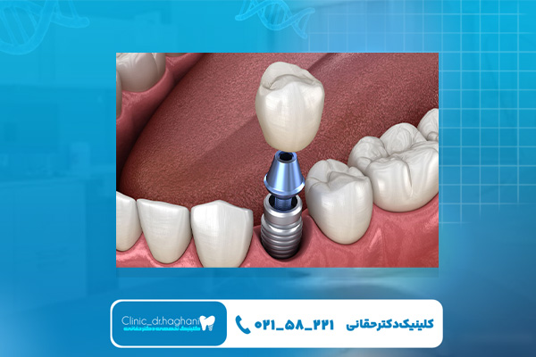 مزیتهای ایمپلنت فوری