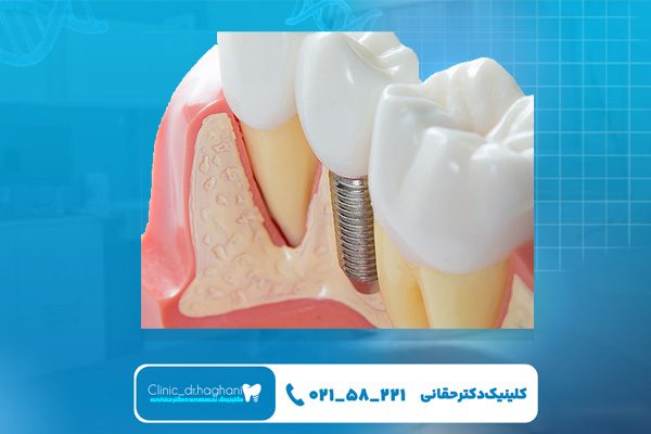 ایمپلنت فوری در دندانپزشکی تخصصی ایمپلنت فوری در دندانپزشکی تخصصی