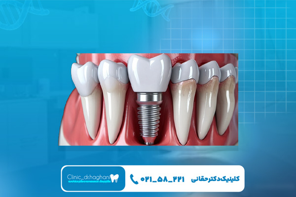 مزیتهای ایمپلنت کرهای مزیتهای ایمپلنت کرهای