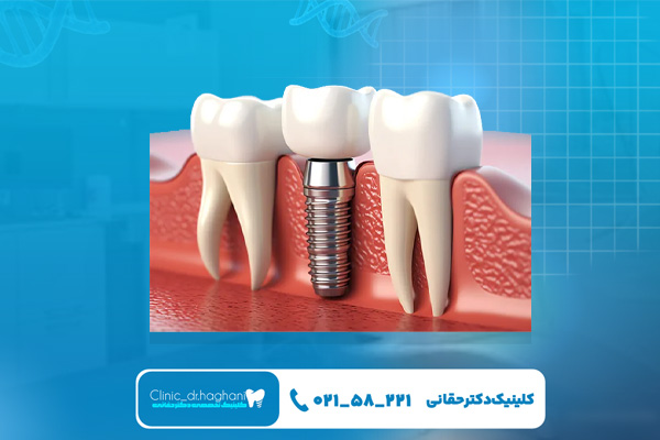 ایمپلنت کرهای بهتر است یا سوئیسی ایمپلنت کرهای بهتر است یا سوئیسی