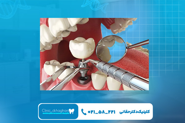 فرق بین ایمپلنت معمولی و یک روزه