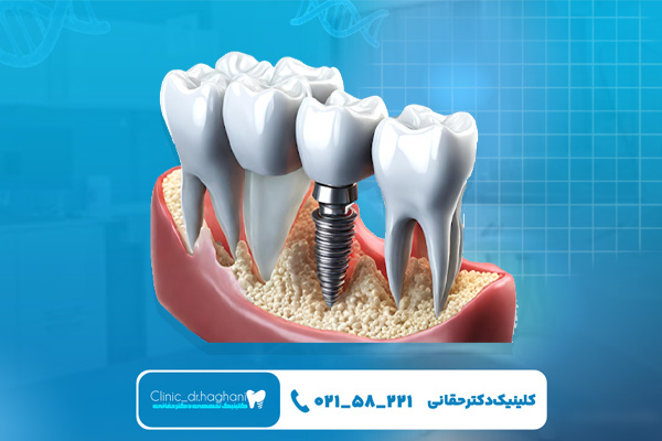 مزیت‌های ایمپلنت یک روزه