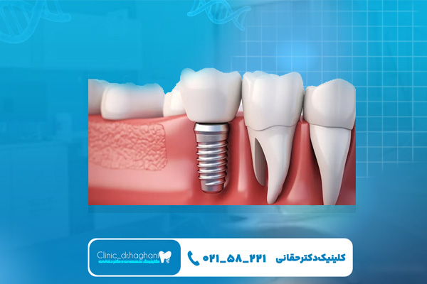 ایمپلنت یک روزه در تهران