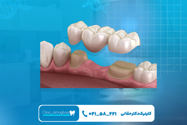 مراحل ایجاد و نصب پروتز دندان