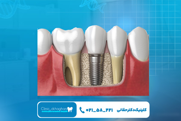 بهترین روش کاشت ایمپلنت در ایران