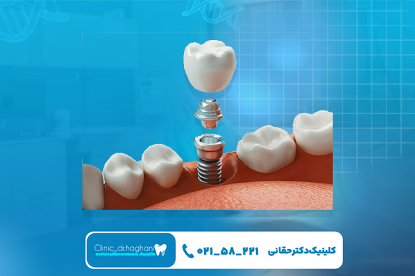  بهترین روش کاشت ایمپلنت