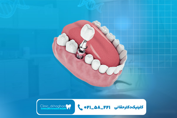 بهترین کلینیک ایمپلنت شمال تهران بهترین کلینیک ایمپلنت شمال تهران