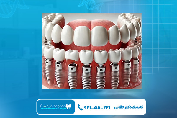 بهترین سن برای انجام ایمپلنت بهترین سن برای انجام ایمپلنت