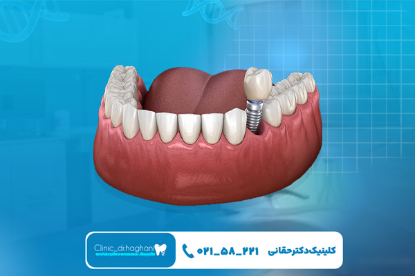 کاشت دندان با بهترین برند ایمپلنت دندان در تهران کاشت دندان با بهترین برند ایمپلنت دندان در تهران