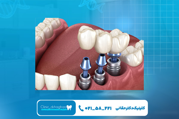 نکات اصلی در انتخاب برند ایمپلنت دندان نکات اصلی در انتخاب برند ایمپلنت دندان