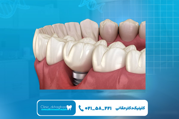 بهترین برند ایمپلنت دندان بهترین برند ایمپلنت دندان