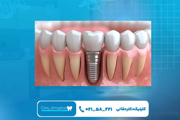 بهترین دندانپزشک کاشت دندان در تهران بهترین دندانپزشک کاشت دندان در تهران