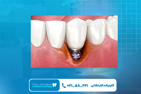 بهترین دندانپزشک ایمپلنت در تهران بهترین دندانپزشک ایمپلنت در تهران