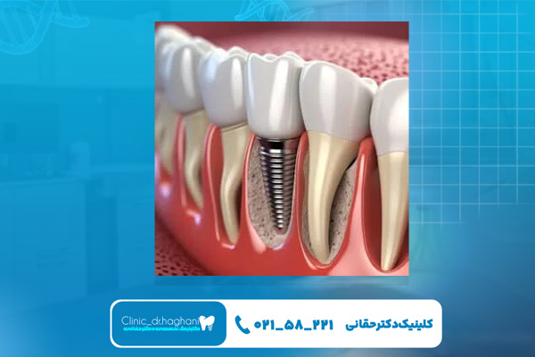 چگونه بهترین دندانپزشک برای ایمپلنت را انتخاب کنیم؟ چگونه بهترین دندانپزشک برای ایمپلنت را انتخاب کنیم؟