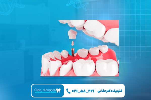 مراحل ایمپلنت‌ دندان