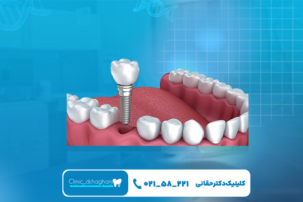 کلینیک دندانپزشکی دکتر حقانی برای ایمپلنت