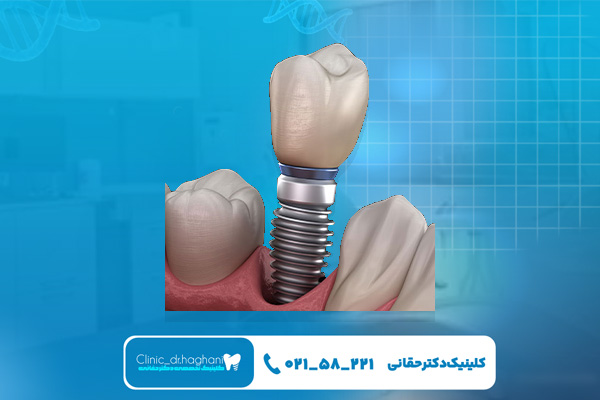 بهترین دندانپزشک ایمپلنت در شمال تهران