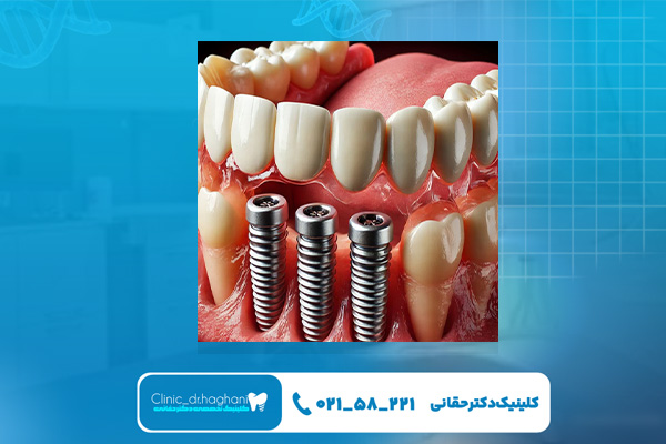 بهترین دندانپزشک ایمپلنت غرب تهران