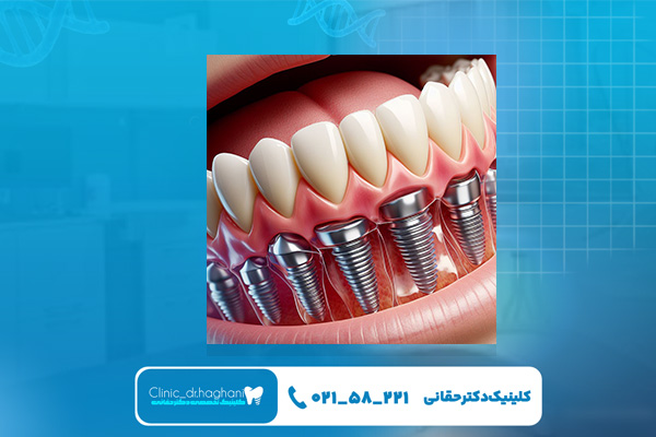  دندانپزشک ایمپلنت غرب تهران