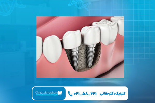 قیمت خدمات بهترین دندانپزشک ایمپلنت‌ غرب تهران