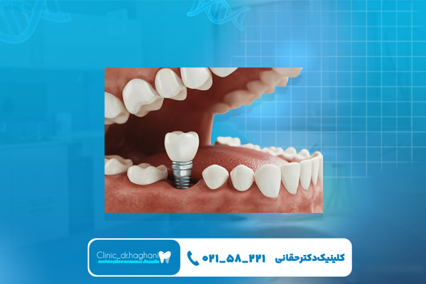 انتخاب کلینیک ایمپلنت در شمال تهران انتخاب کلینیک ایمپلنت در شمال تهران