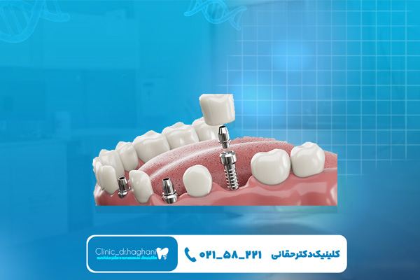 خدمات تخصصی ایمپلنت دیجیتال در بهترین کلینیک ایمپلنت مرکز تهران خدمات تخصصی ایمپلنت دیجیتال در بهترین کلینیک ایمپلنت مرکز تهران