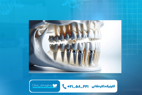 بهترین کلینیک ایمپلنت مرکز تهران بهترین کلینیک ایمپلنت مرکز تهران