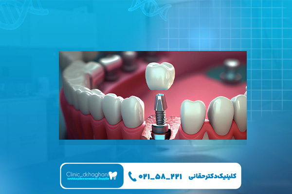  ایمپلنت دیجیتال بهتر است یا تخصصی؟