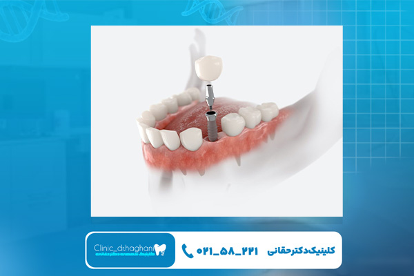 اصلی‌ترین فرق ایمپلنت دیجیتال و تخصصی