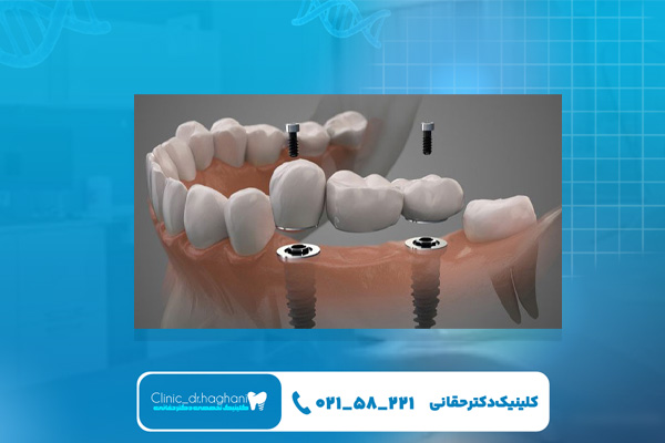 تفاوت‌های ایمپلنت دیجیتال و تخصصی