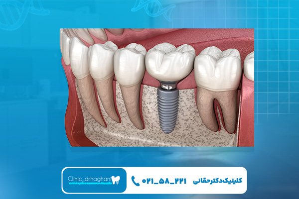 دندانپزشک ایمپلنت دندان در کلینیک دندانپزشکی دکتر حقانی