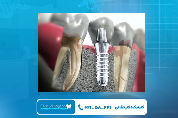 انواع کاشت ایمپلنت دندان