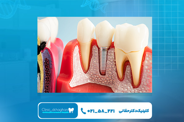 دندانپزشک ایمپلنت