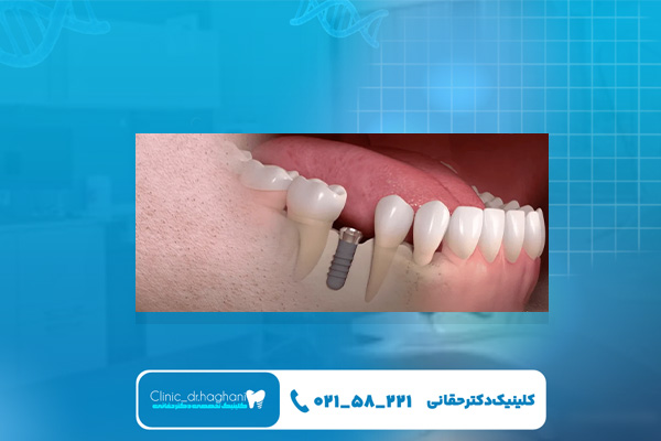 مزایای کاشت دندان