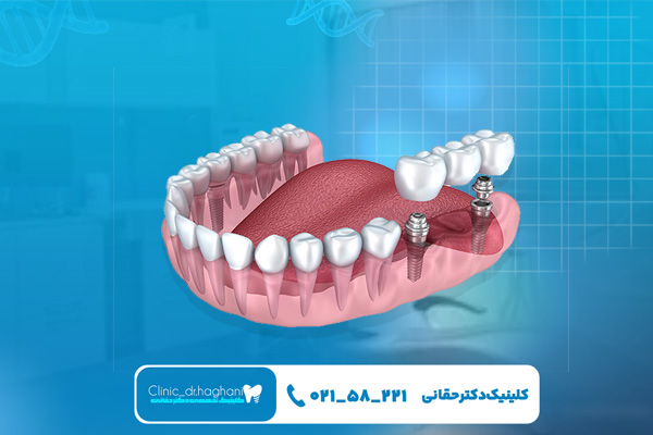 دندانپزشک متخصص ایمپلنت شمال تهران